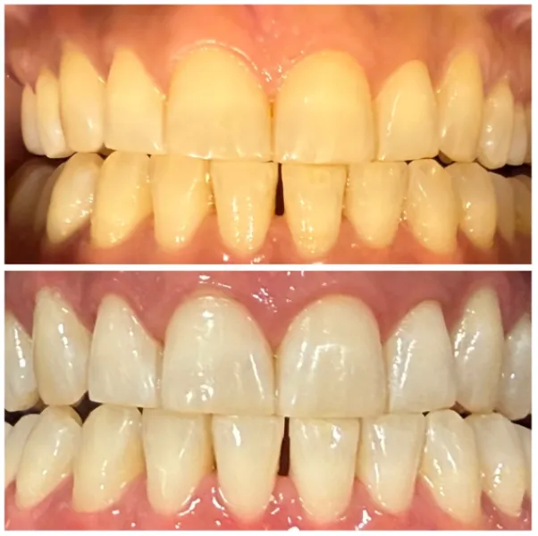 Zoom Teeth Whitening: What to Check Before Booking Treatment