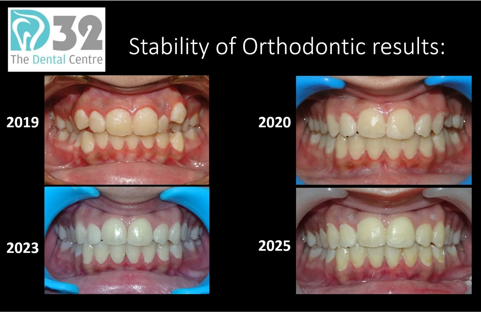 Stability of Orthodontic Results: Making Results Last