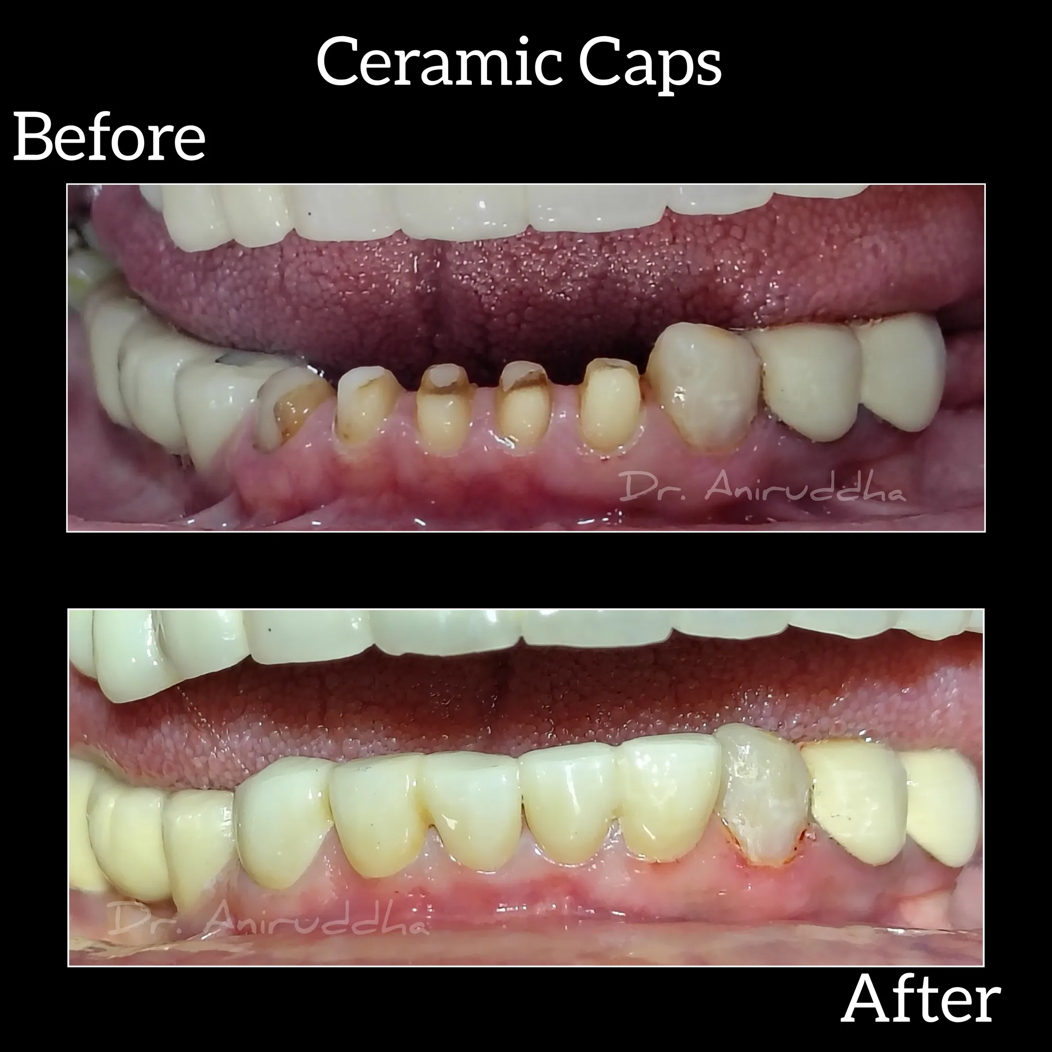 best dentist at nibm undri #dental #dentist #dentistry #smile #teeth #dentalcare #dentista #dentalcl...