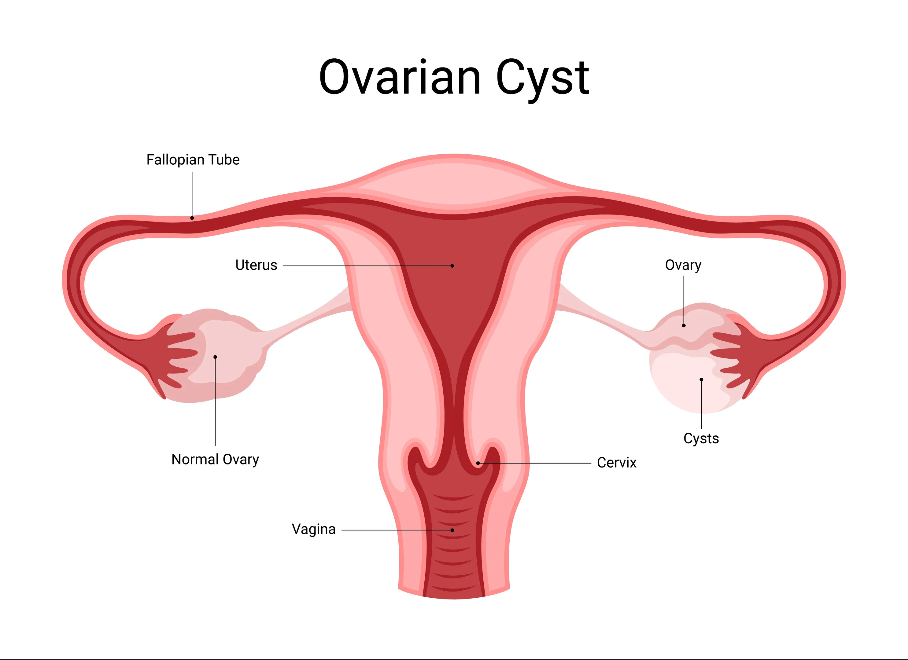 Ovarian Cyst Treatment in Sanpada: When Does a Cyst Need Medical Attention?