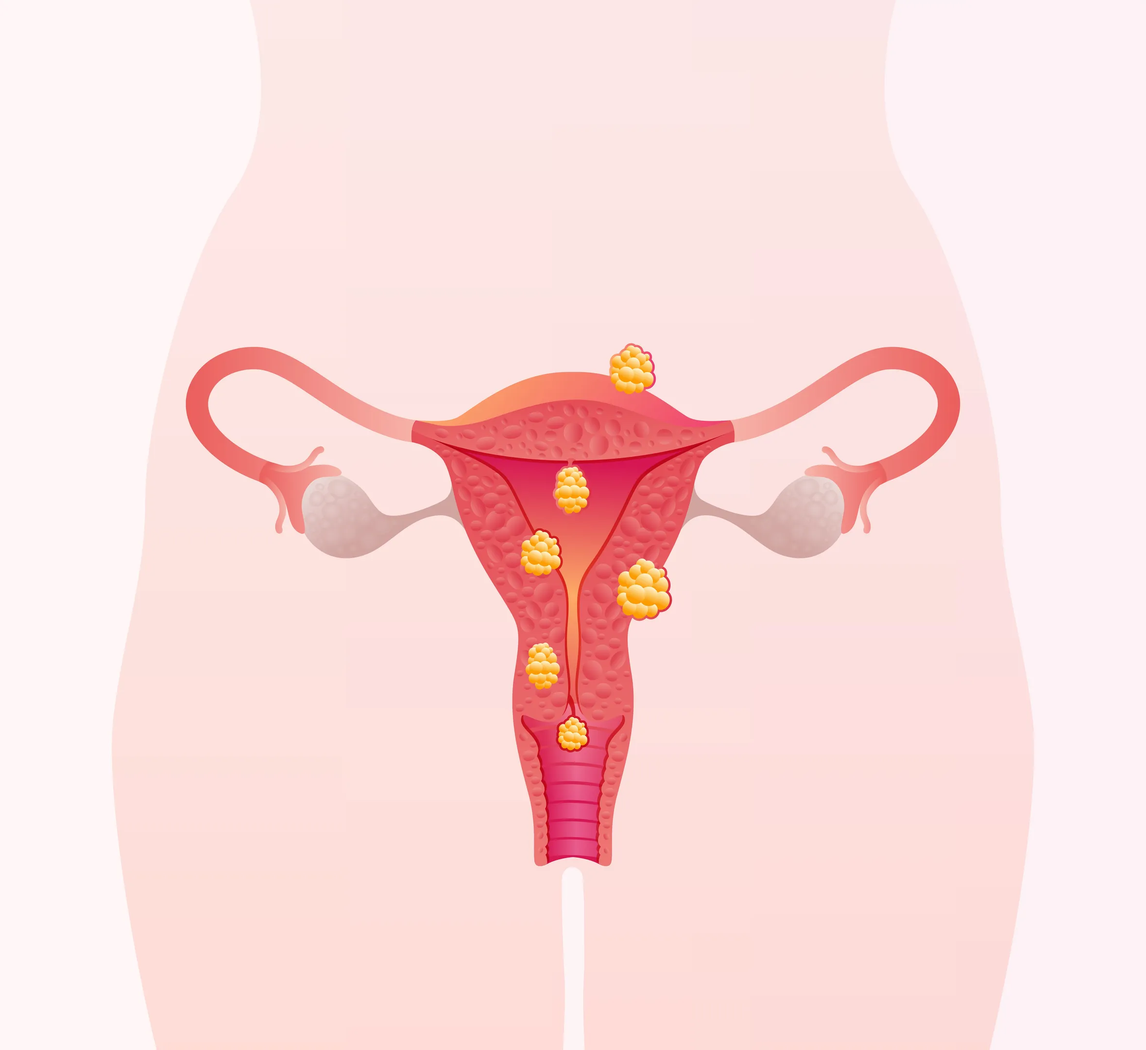 Fibroids Treatment in Sanpada: How to Choose the Right Treatment Approach