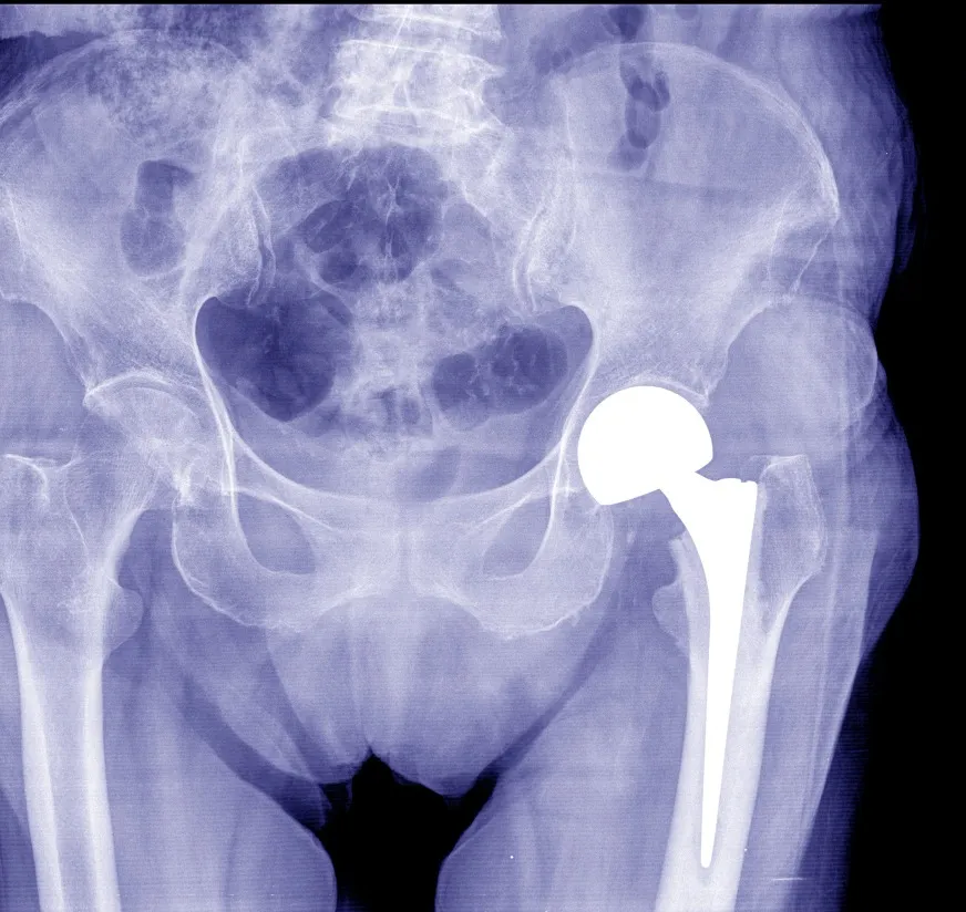 Total Hip Replacement Surgery Compared With Continued Conservative Care