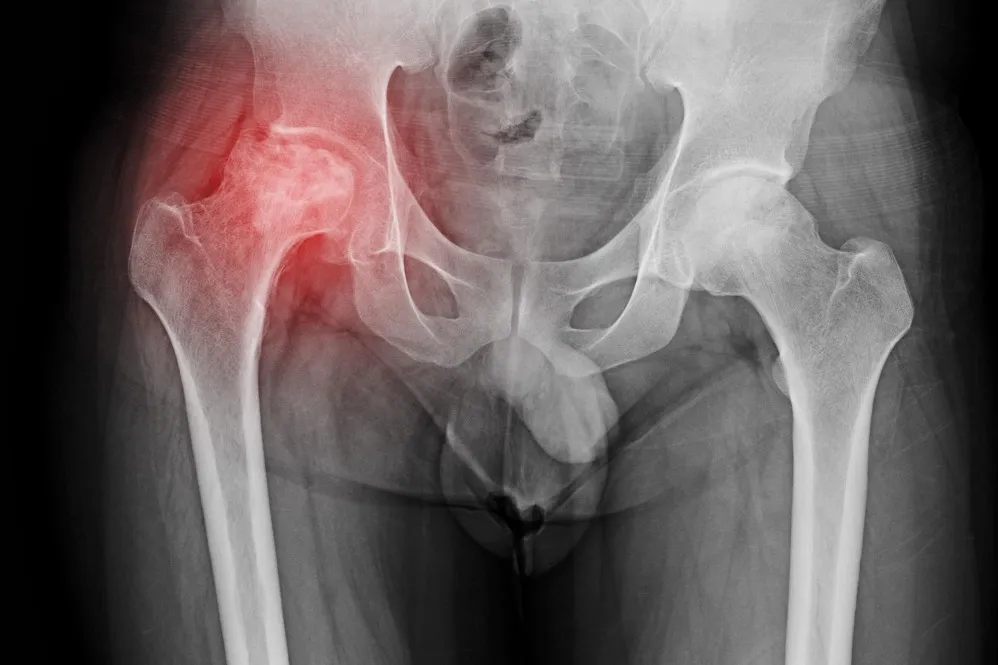 Making Daily Movement Easier Through Hip Arthritis and Hip Pain Care