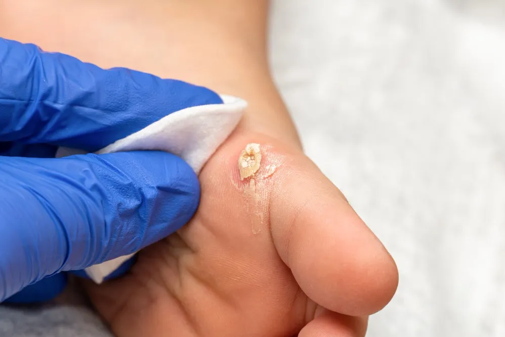 Corn Removal Treatment Specialist Care Beyond Home Remedies