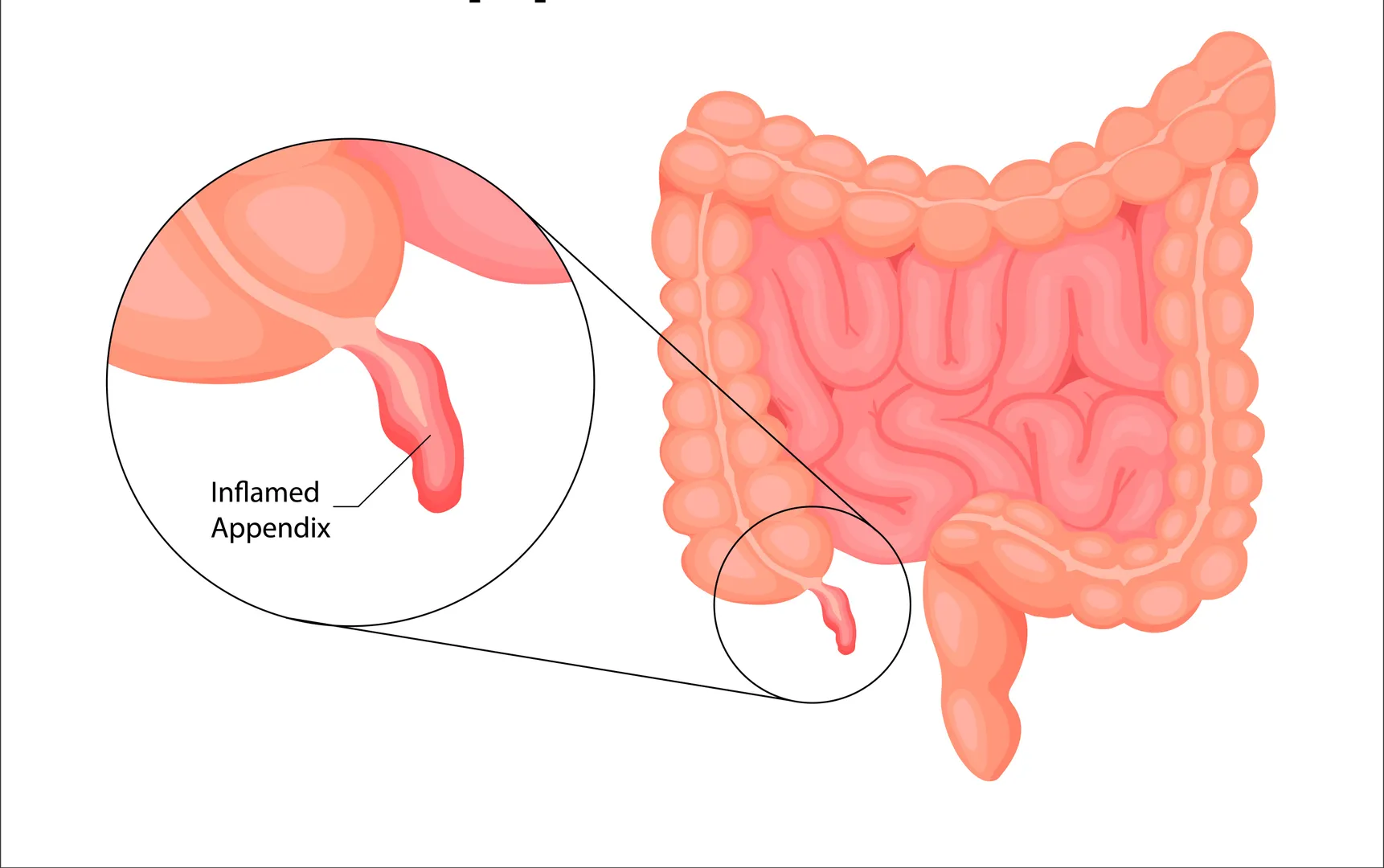 Preparing for Appendix Surgery After an Appendicitis Diagnosis