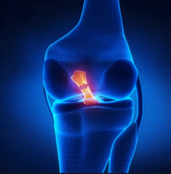 ACL Treatment in Mumbai Can an ACL Injury Heal Without Surgery?