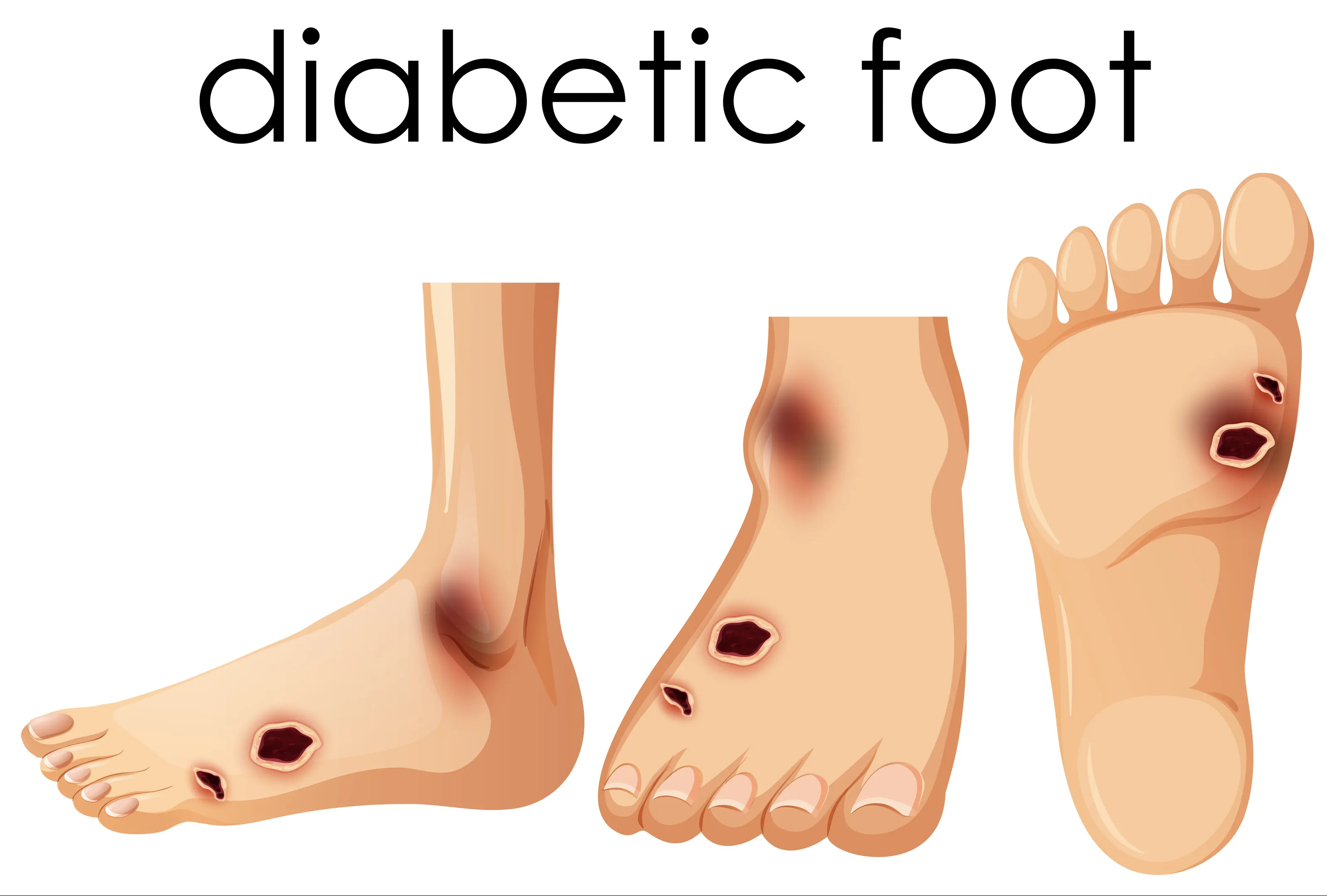 Diabetic Foot Disease Treatment in Goregaon: When a Wound Needs Urgent Care
