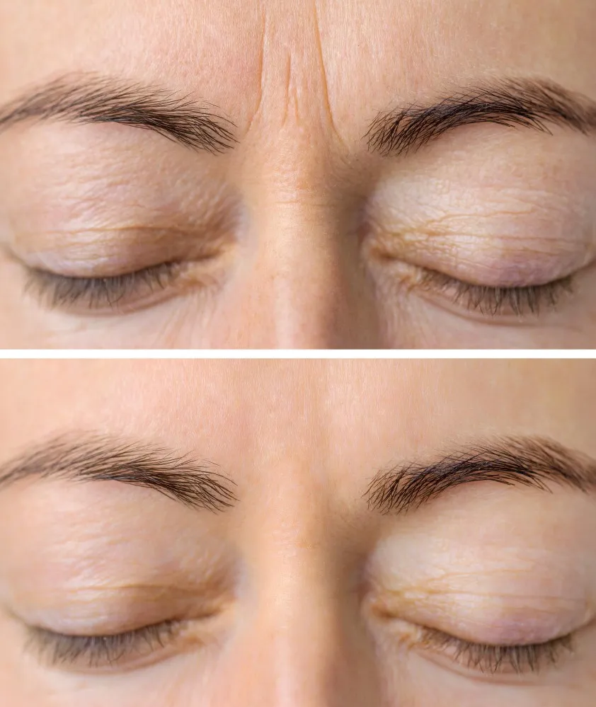 How Wrinkle Treatment Can Soften Visible Signs of Ageing Naturally