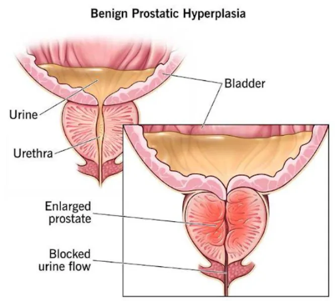 Understanding Benign Prostatic Hypertrophy and Its Effect on Urination