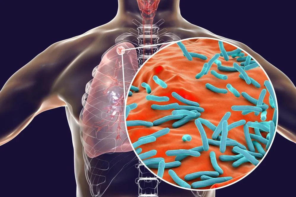 What to Expect from a Tuberculosis Management Specialist in Pune