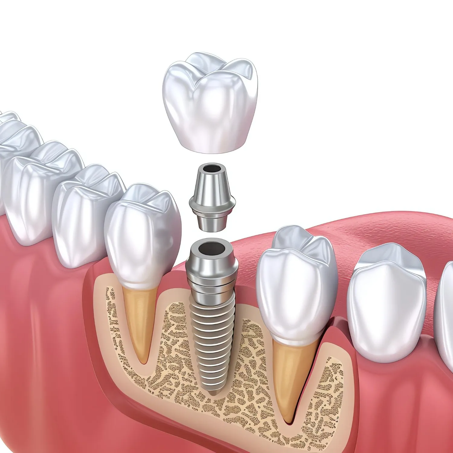 Best Dental Implants in Vasna-Bhayli and What Patients Should Know Before Treatment