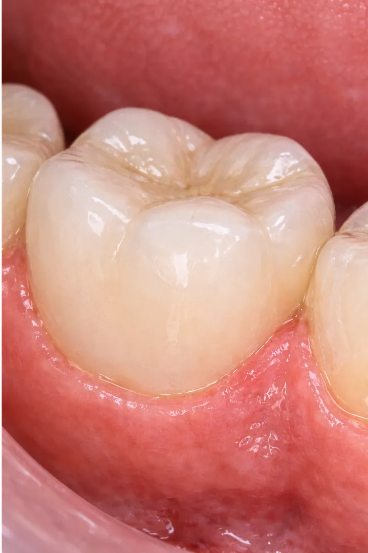 How Zirconia Restorations Combine Strength With a Natural Dental Appearance