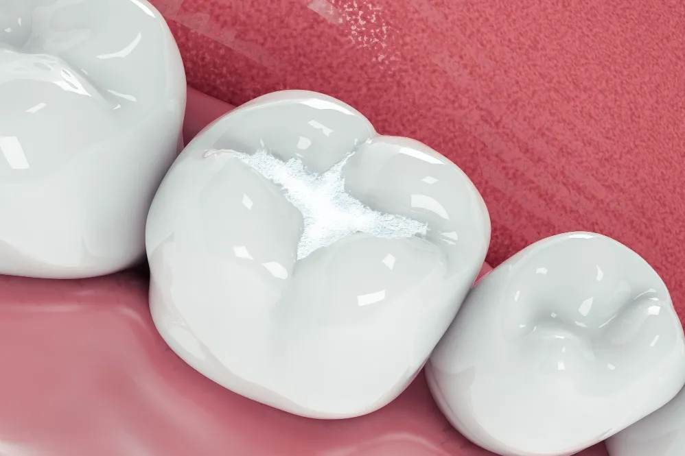 When a Tooth Filling Can Help Protect a Damaged Tooth