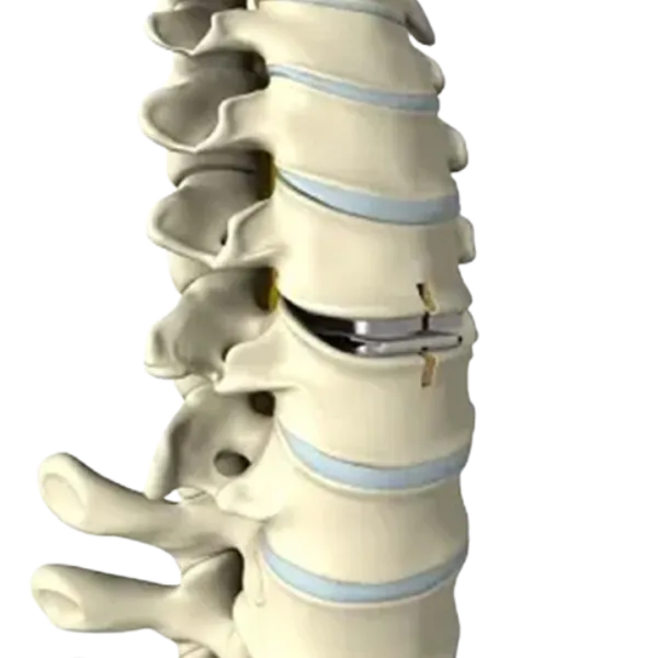 Lumbar Microdiscectomy Surgery in Pune | Maharashtra | India |