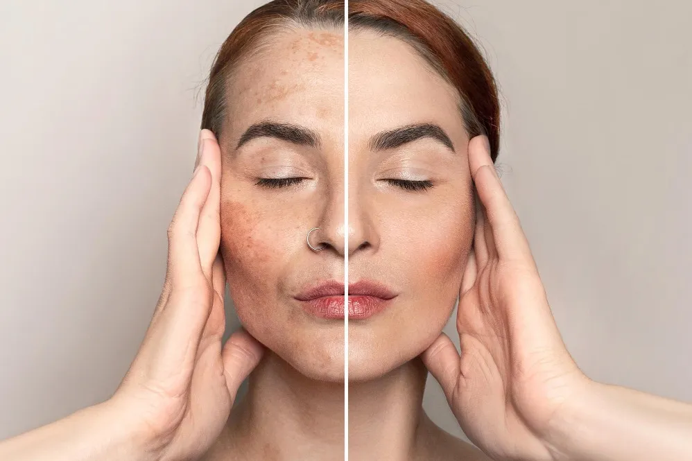 What Causes Uneven Skin Tone and When Pigmentation Treatment May Help in Wakad