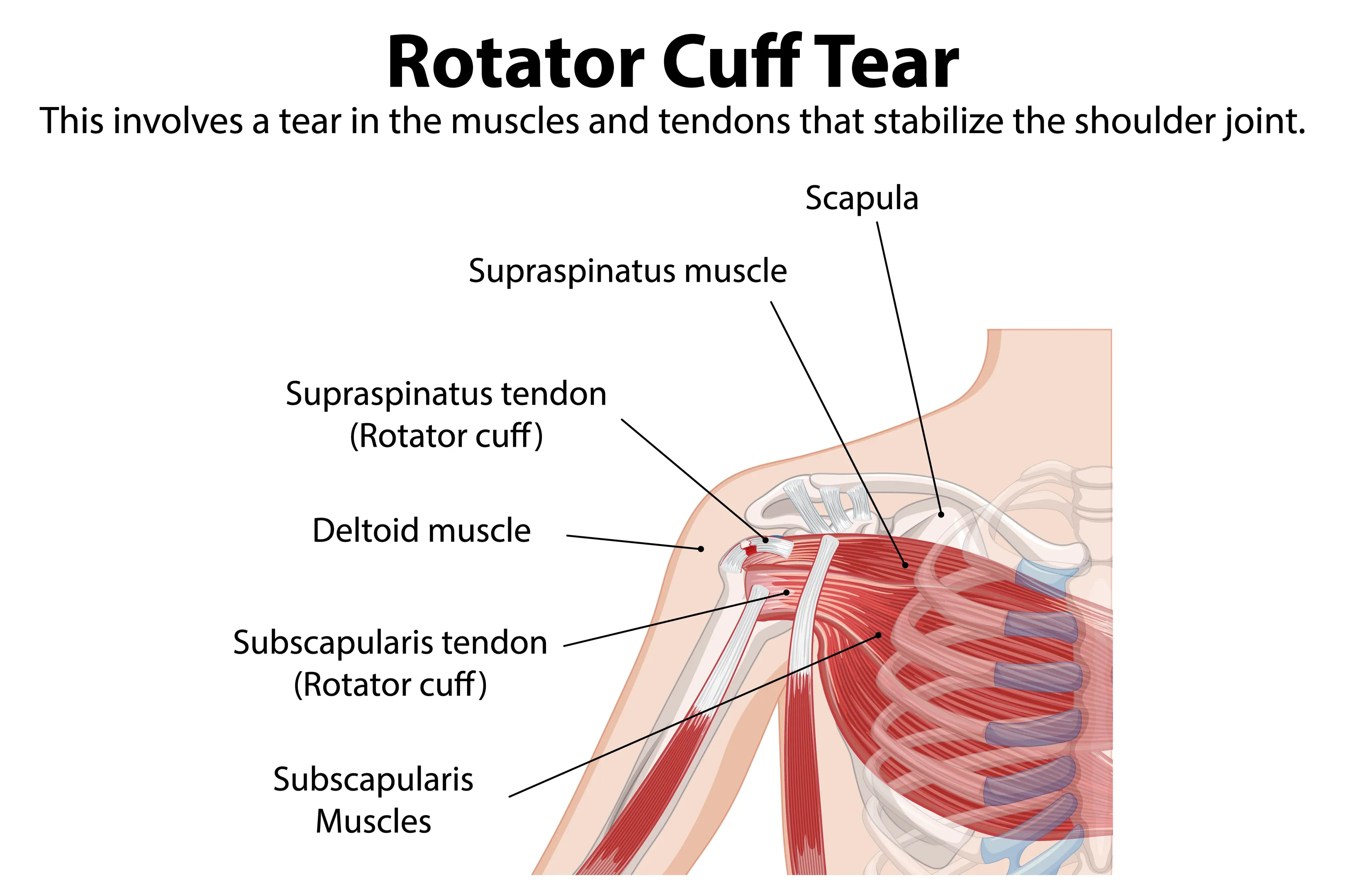 Rotator Cuff Tear Doctor in Nagpur or Physiotherapy Which Should You Consider First?