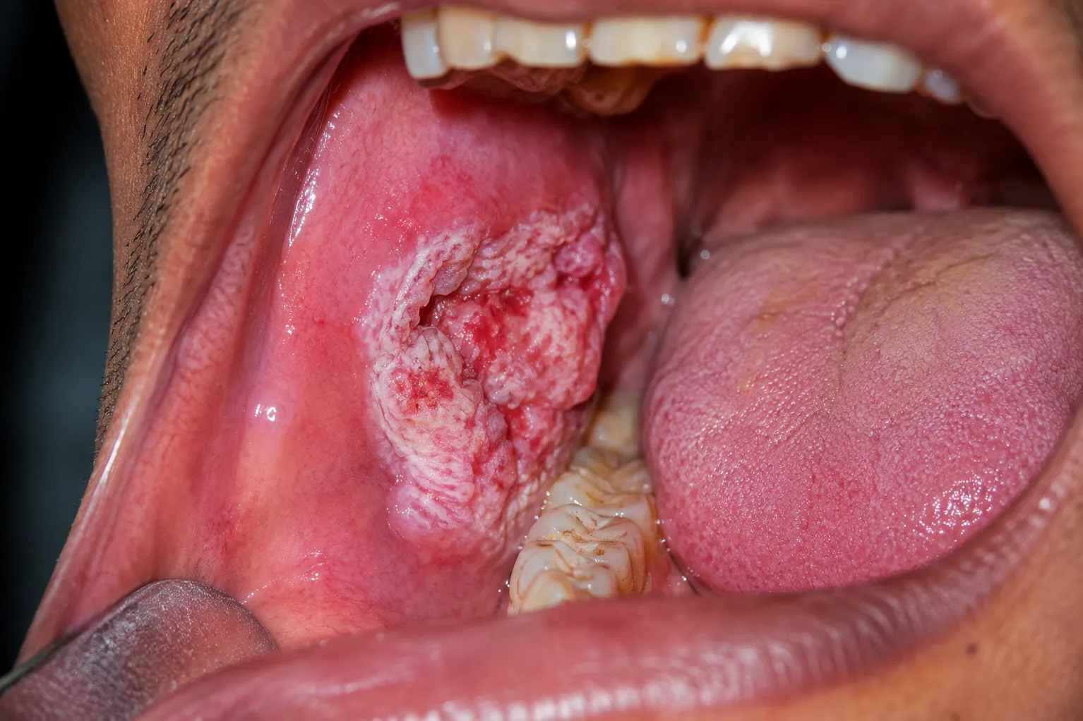 How an Oral Cancer Surgeon Plans Treatment for Mouth Cancer