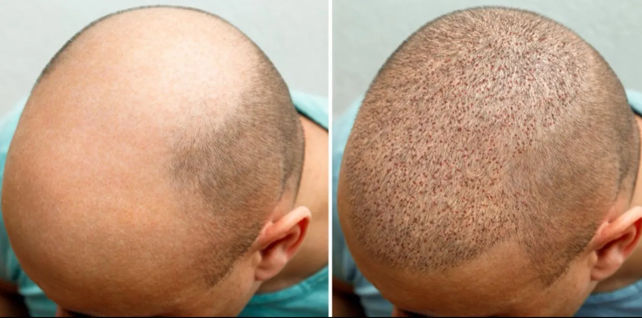 How to Choose a Hair Transplant Clinic in Bengaluru