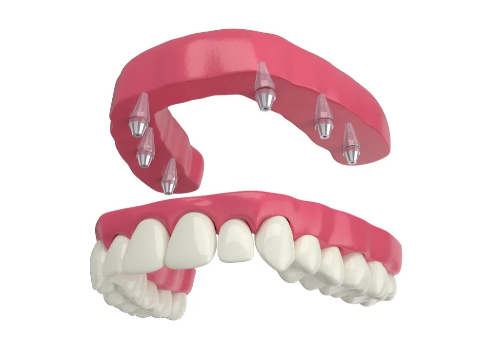 Full Mouth Implants in Dwarka Explained for Patients With Multiple Missing Teeth