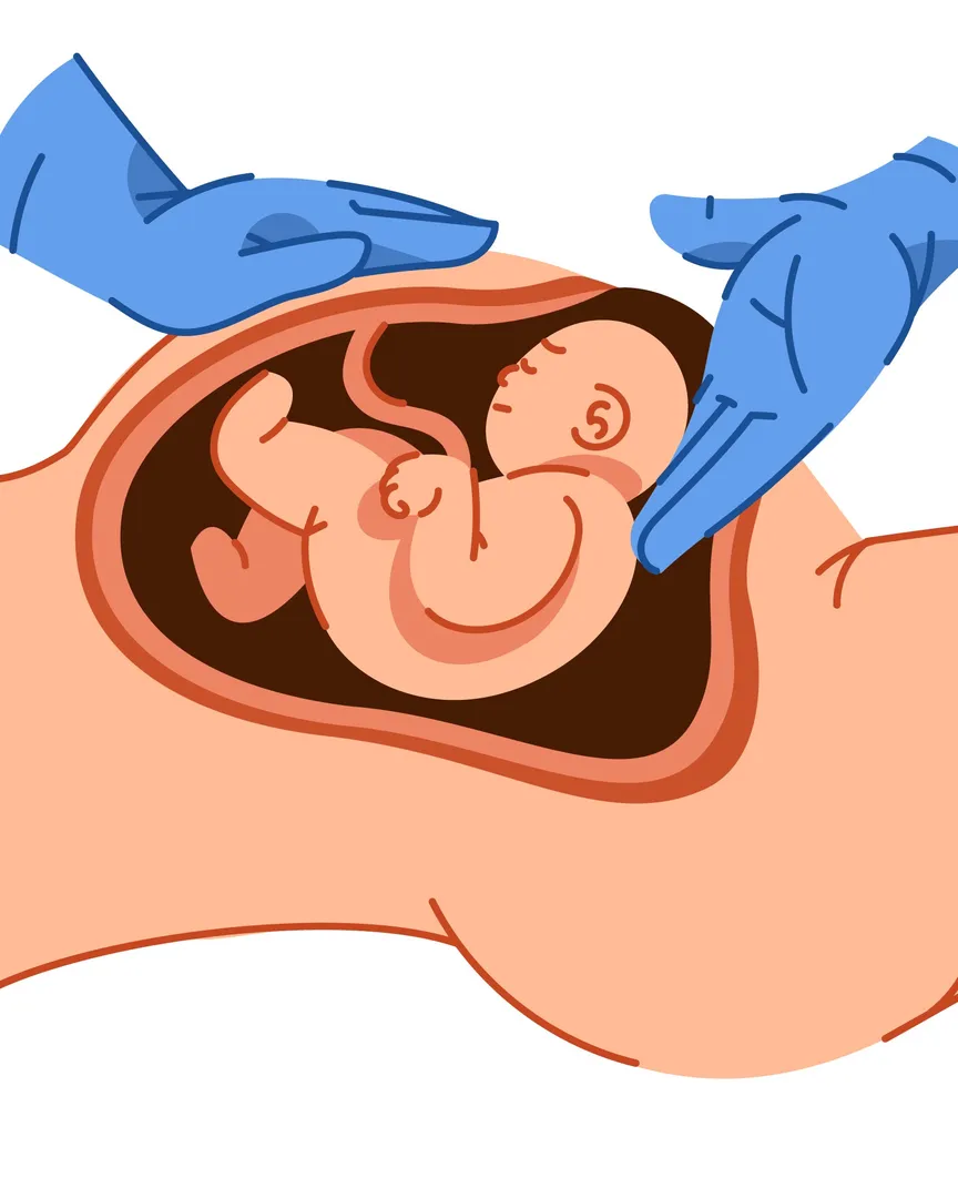 Caesarean Section Specialist in Airoli, Navi Mumbai and How to Know When a C Section Is Needed