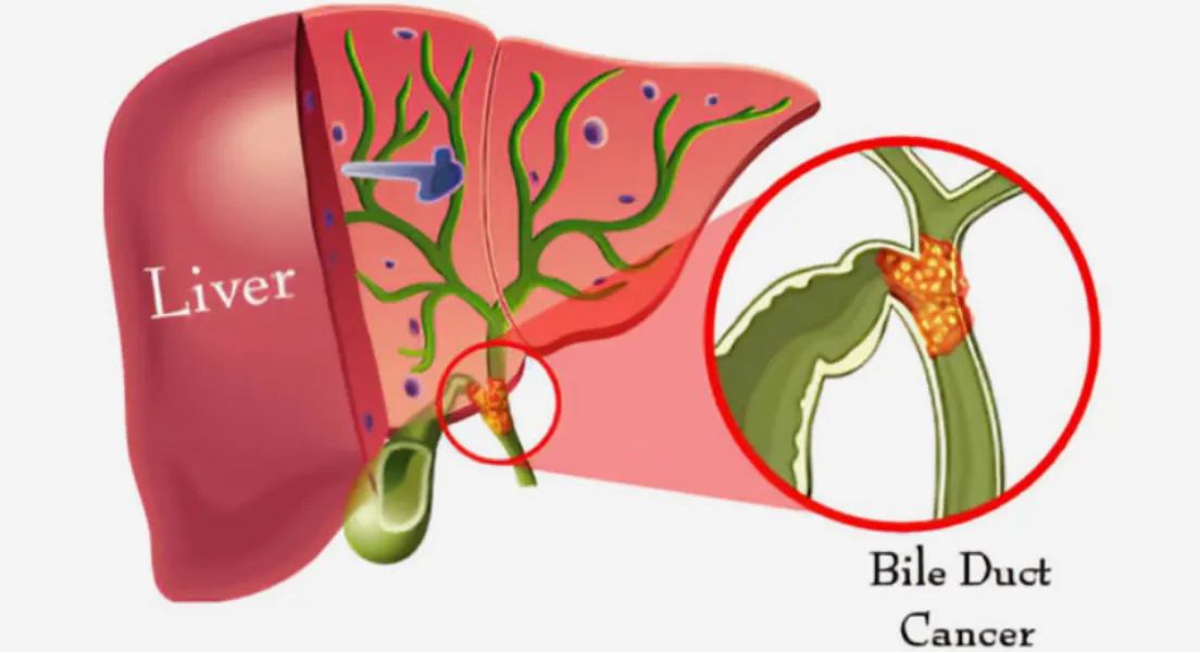 Understanding Bile Duct Cancer Treatment Before Making Healthcare Decisions