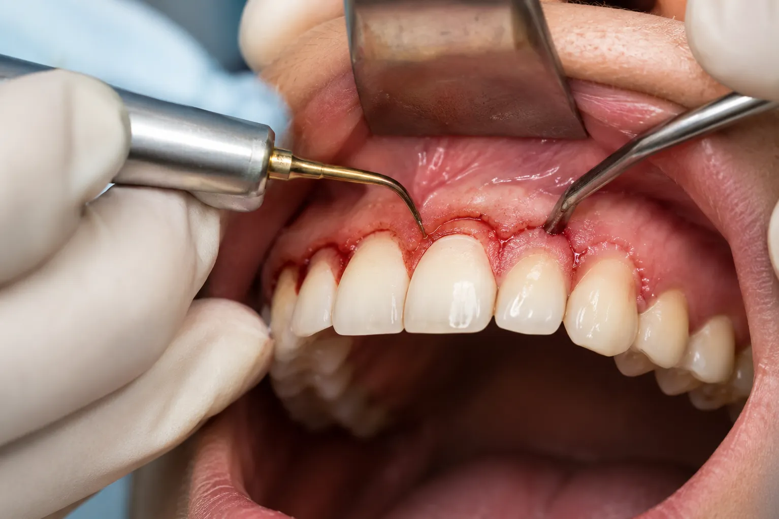 When Crown Lengthening Helps Improve Tooth Access and Gum Proportions