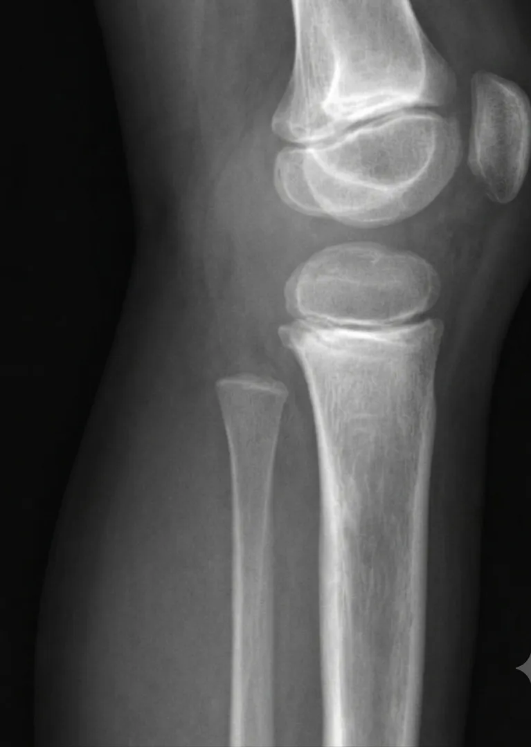 Ewing Sarcoma Why Persistent Bone Pain in Young Patients Needs Attention
