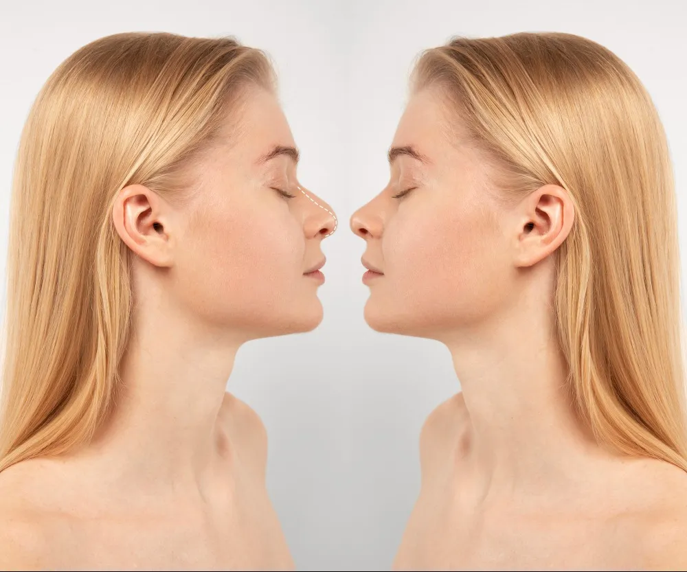 Non-Surgical Nose Reshaping What It Can and Cannot Correct