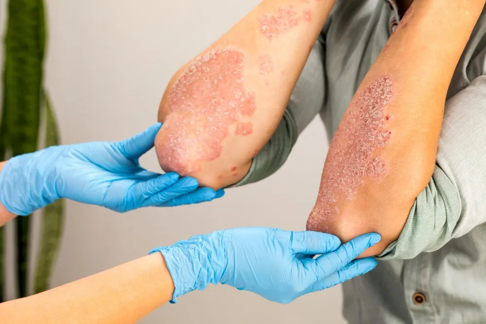 When Psoriasis Treatment Needs a Long-Term Skin Management Plan
