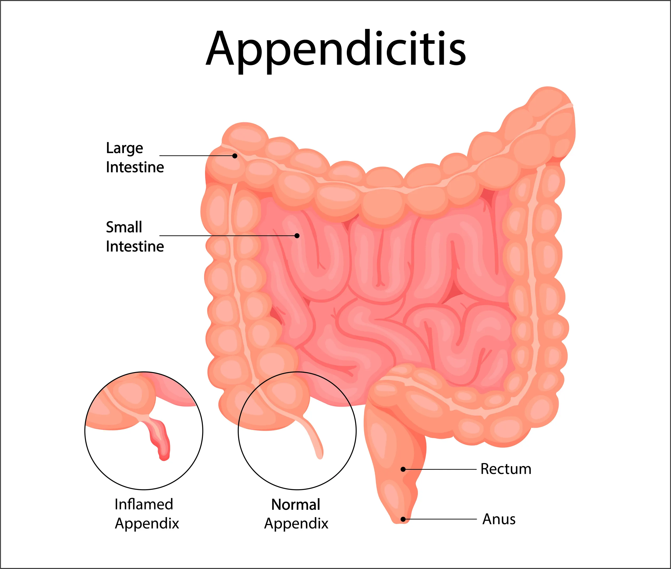 Appendicitis Symptoms You Should Not Ignore in Goregaon
