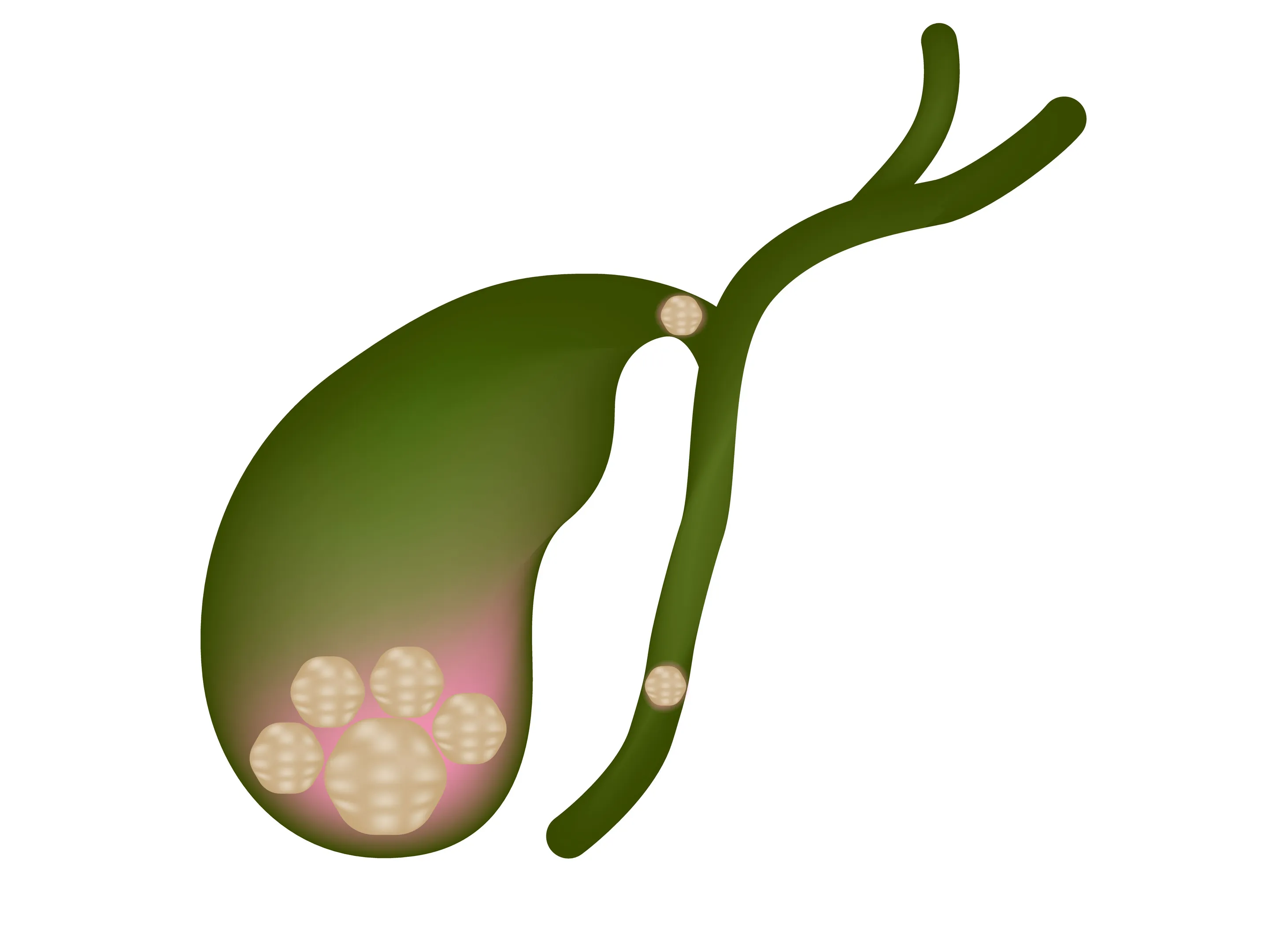 Gallstone Treatment Specialist in Thane Explains When Observation May Not Be Enough