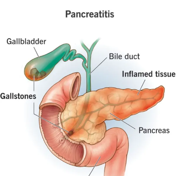 Recurrent Pancreatitis Needs More Than Temporary Pain Relief