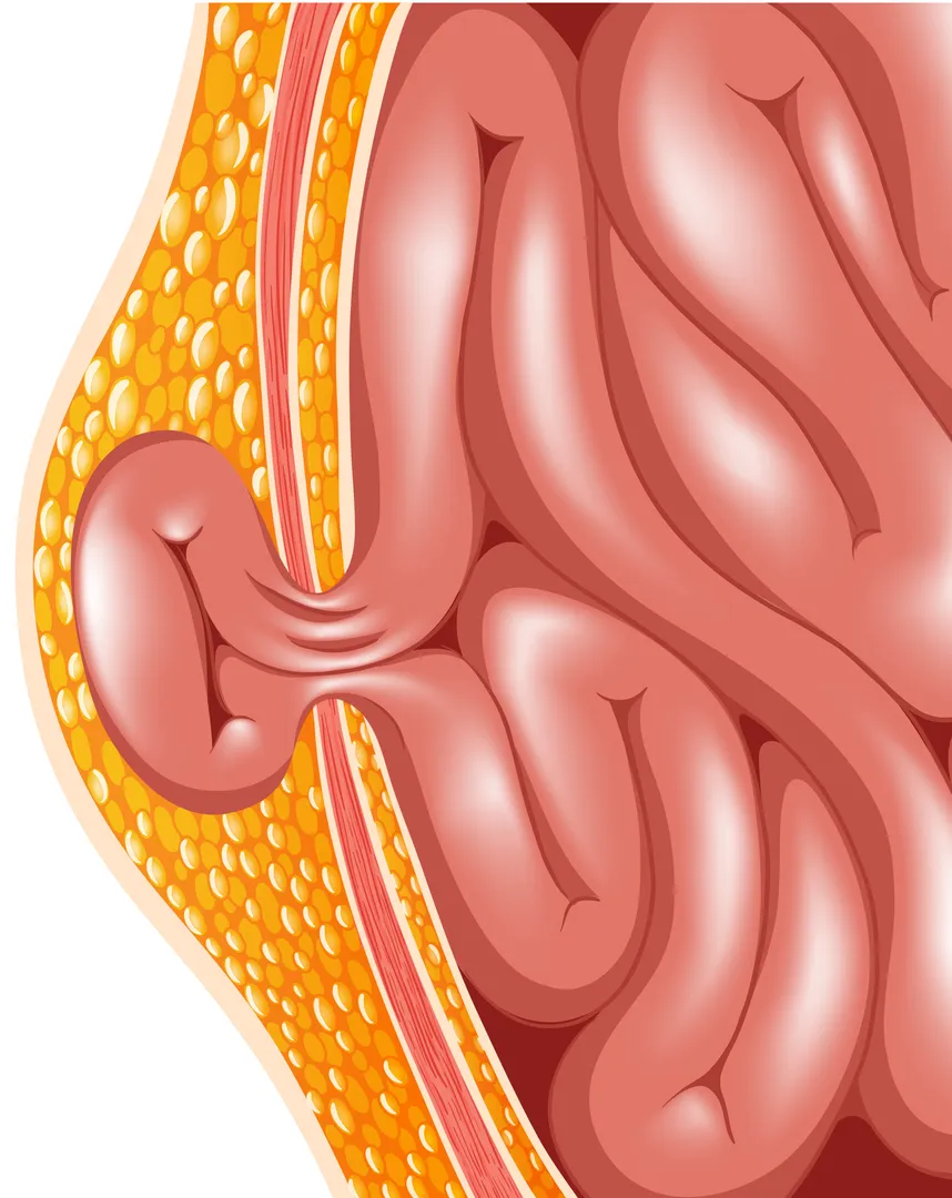 Hernia Surgery Hospital in Dhankawadi/Katraj/Bibwewadi/Kondhwa/Undri/Wanowrie/Swargate/Pune