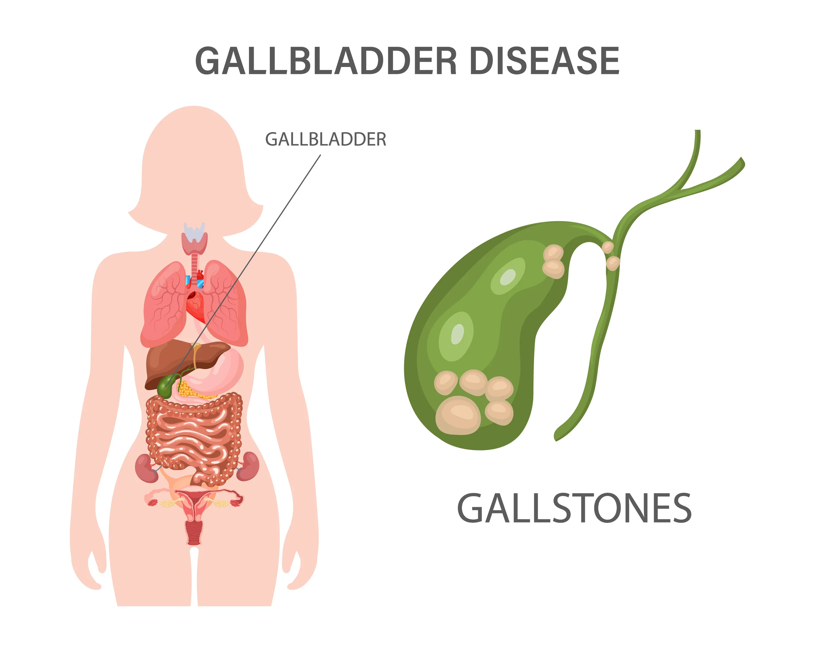 Gall Bladder Stone Disease Symptoms and Treatment Options in Goregaon