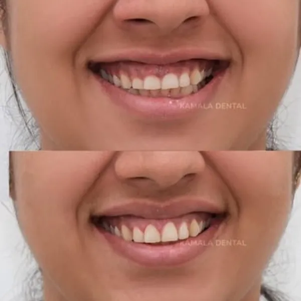 Smile correction In Vashi