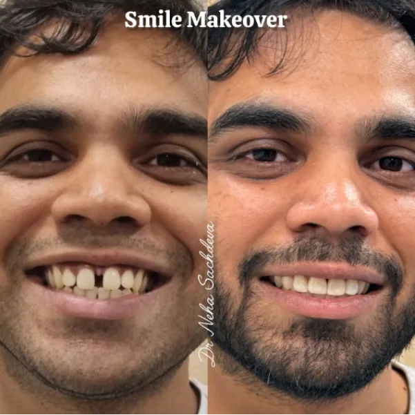 What a Smile Makeover Specialist Considers Before Changing Your Smile in East of Kailash