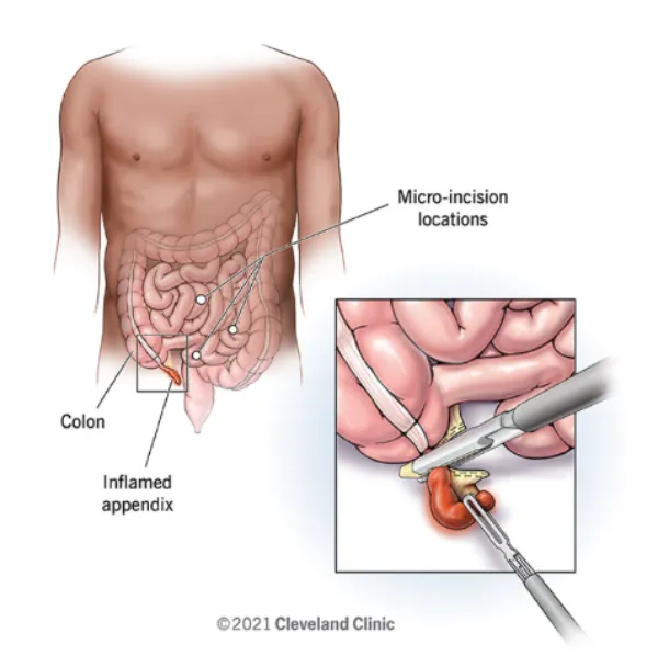 Appendix Surgery in Airoli and What Happens When Appendicitis Is Suspected