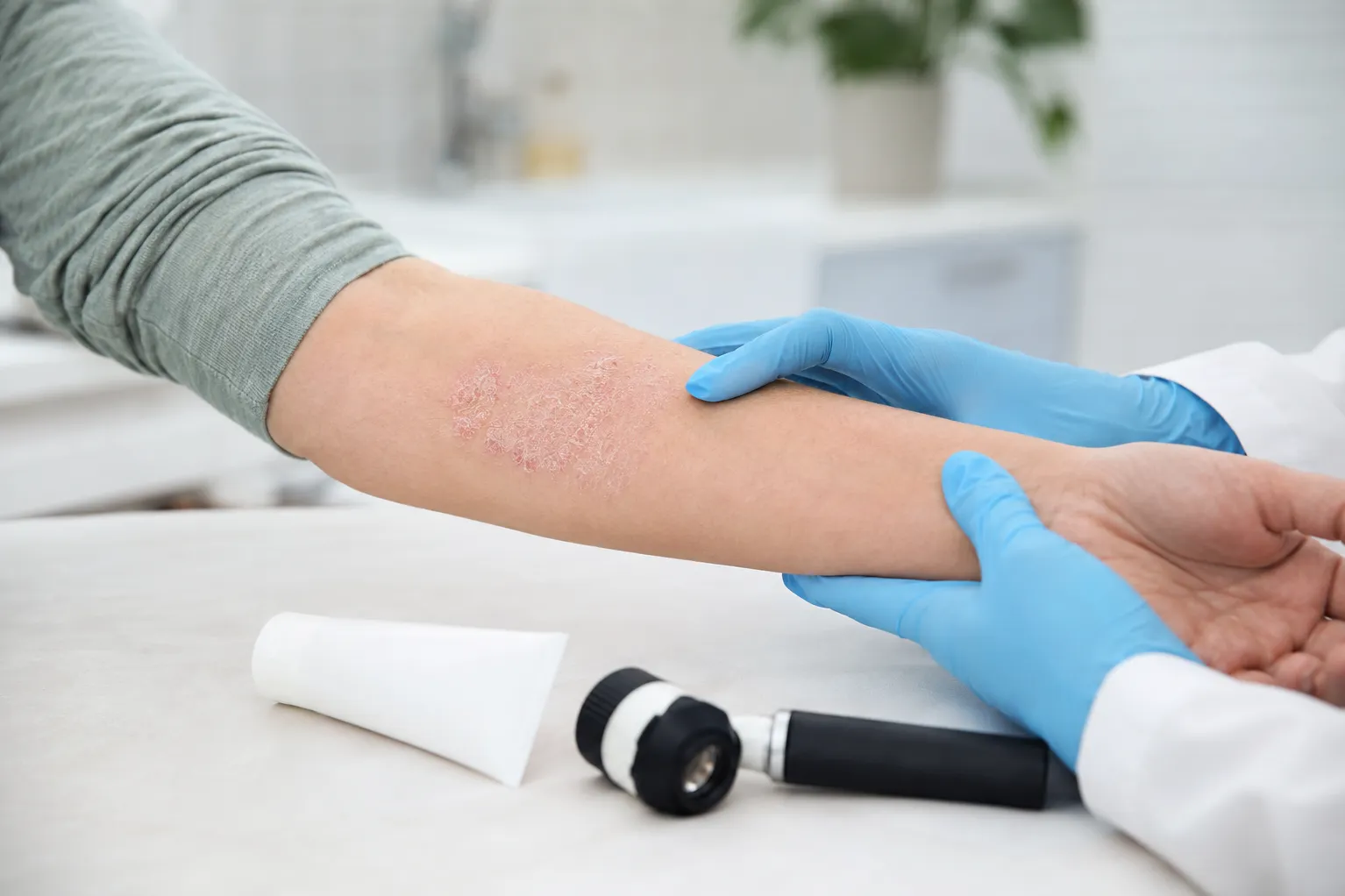 Psoriasis Treatment in Mumbai: Understanding Flare-Ups and Long-Term Skin Care