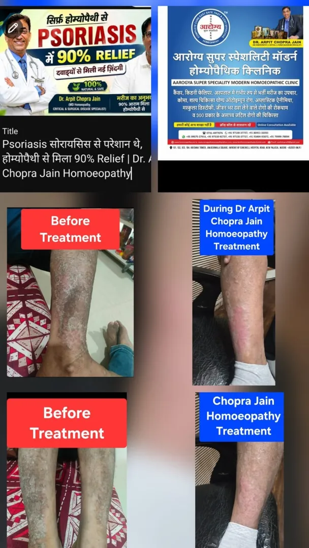 Psoriasis सोरायसिस से परेशान थे, होम्योपैथी से मिला 90% Relief | https://youtu.be/ajRgag3gjJA?s...