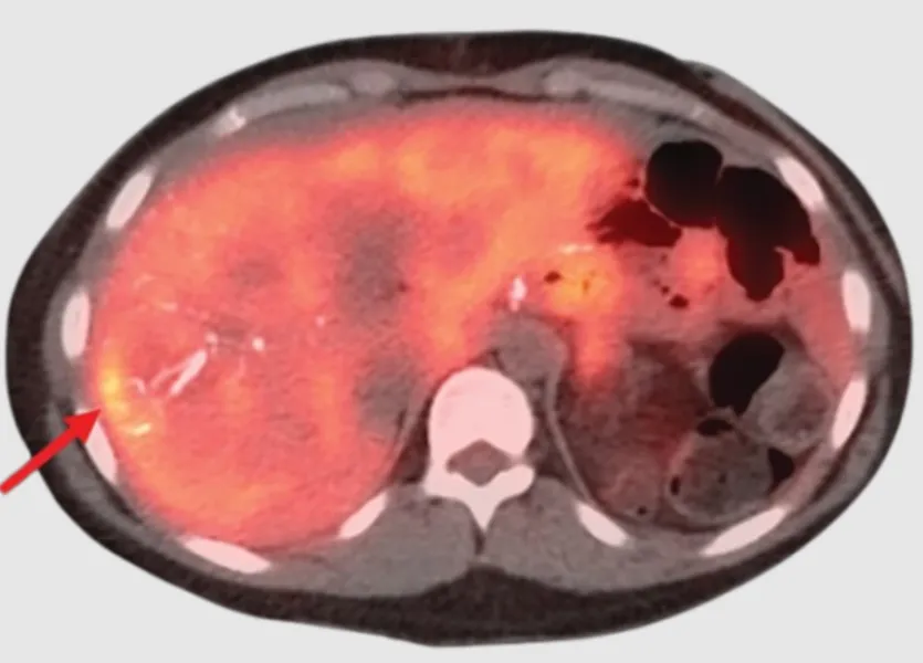 Neuroendocrine Tumors Need Treatment Based on Grade, Site and Disease Behaviour