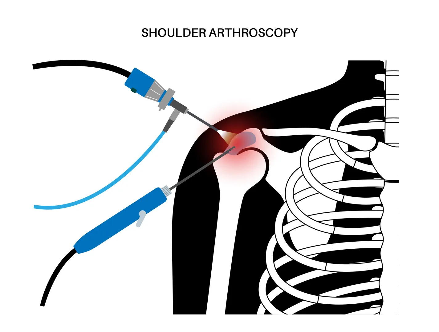 When Shoulder Arthroscopy May Be Used for Pain, Instability, or Sports Injuries