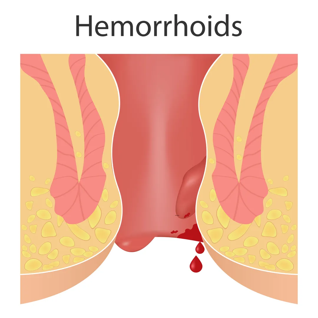 Hemorrhoids Treatment When Should You Seek Medical Care Instead of Home Remedies?