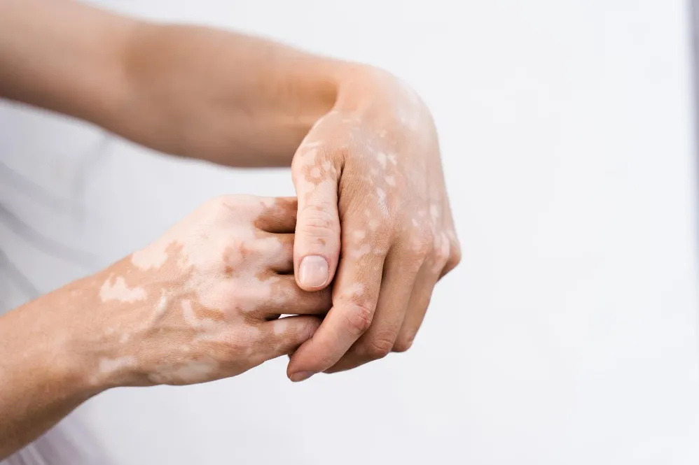 Understanding Vitiligo Treatment and the Importance of Early Dermatology Care