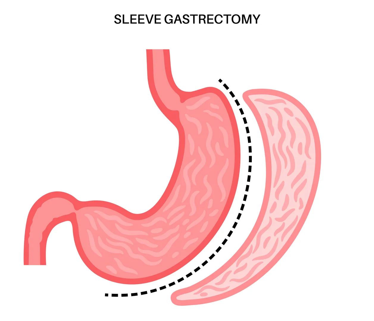 How Sleeve Gastrectomy Fits Into Long Term Obesity Management