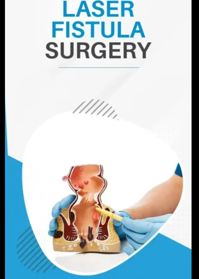Laser Fistula Surgery and What to Consider Before Choosing Treatment
