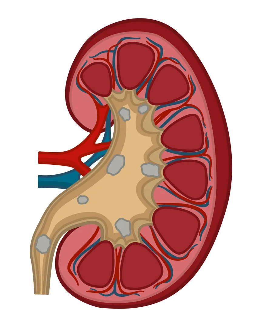 When Minimally Invasive Kidney Stone Treatment May Be Considered