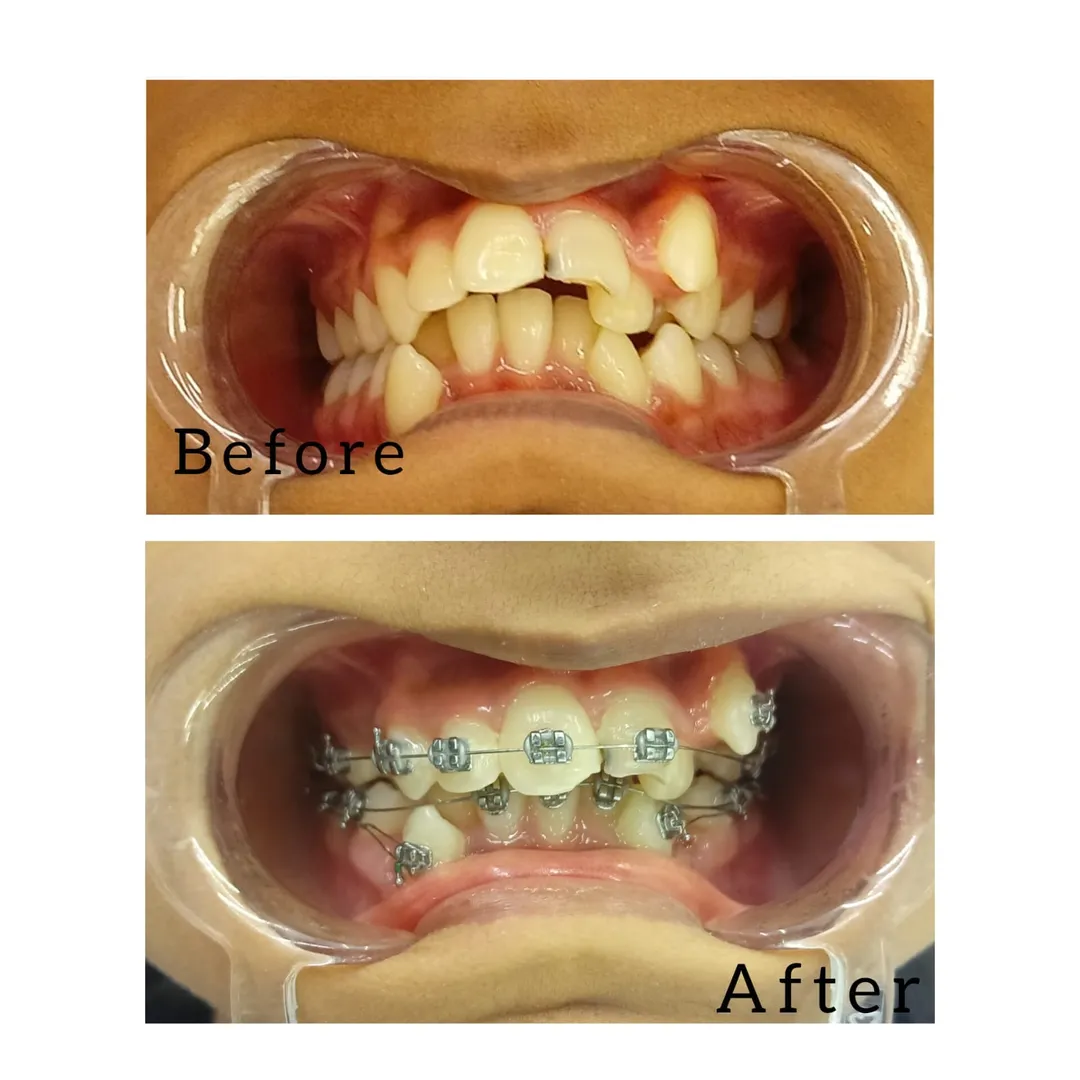 Braces Treatment In Vashi