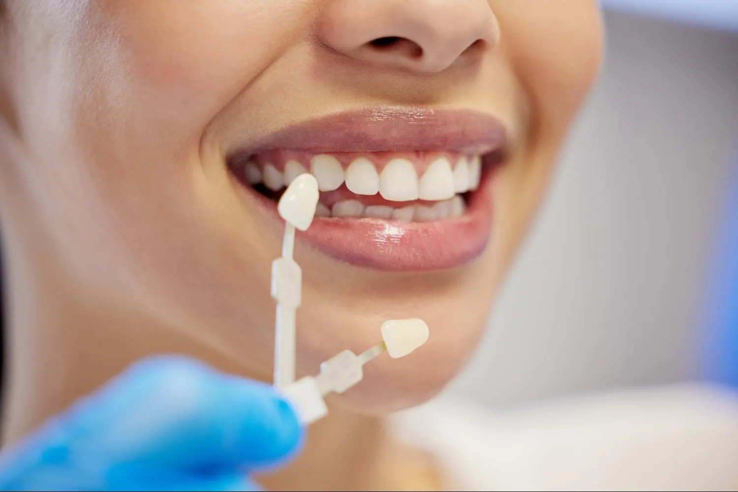 Dental Veneers for a Better Smile What Every Patient Should Know Before Treatment