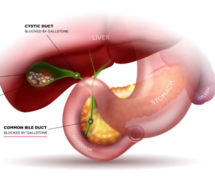 Bile Duct Stones Can Lead to Serious Complications Without Timely Treatment