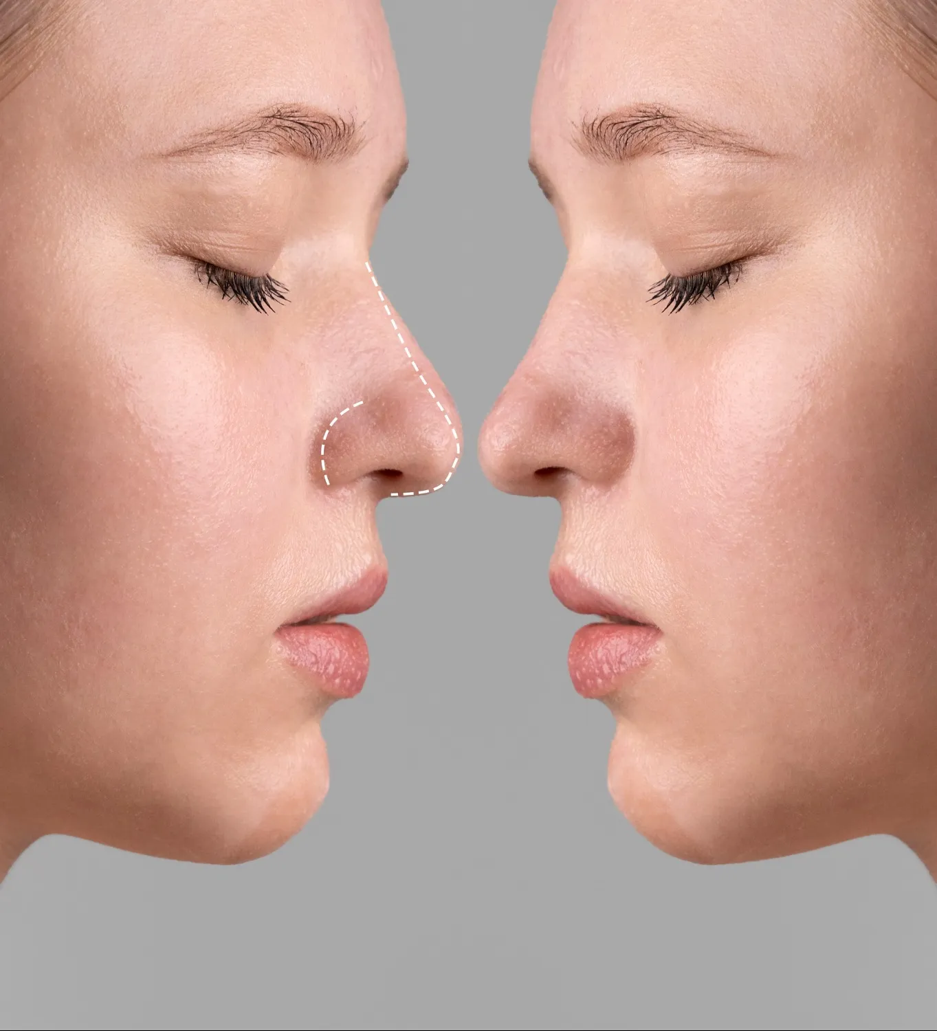 Rhinoplasty in Bengaluru: What the Procedure Can and Cannot Change